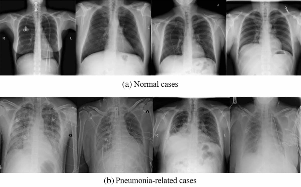 Pneumonia Detection with YOLO and Flask